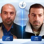 کاشت مو تارا