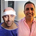 کاشت مو -کاشت ابرو -کاشت ریش شکیبا