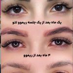 مرکزتخصصی ریموو تتو فریناز کرباسی