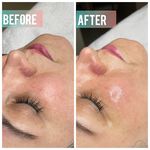 خدمات پاکسازی پوست و فیشال آرمی