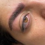 میکروبلیدینگ،فیبروز نسرین رضایی