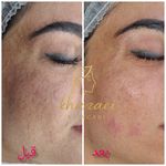 فیشال و پاکسازی پوست درنواب