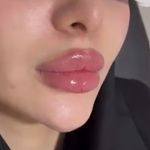 خانه لیزر فیلر و بوتاکس ثنا