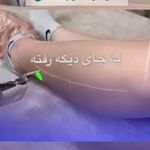 مرکز لیزر موهای زائد نفس