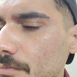 فیشال درمانی و پاکسازی پوست میرجلیلی