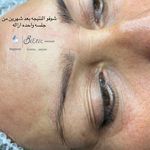 میکروبلیدینگ و فیبروز المیرا