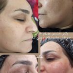 پاکسازی انواع پوست ها درمنزل