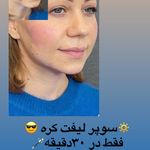 کلینیک ژل بوتاکس لیزر فیل بیوتی