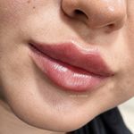 فیلر لب و مادلینک صورت