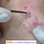فیشال و پاکسازی تخصصی پوست سولماز