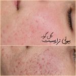 پاکسازی پوست اراک