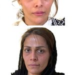 کلینیک هانیل | فیلر و بوتاکس شرق