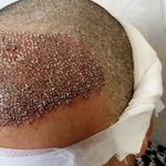 کاشت مو پارساباد