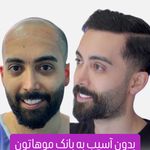 کاشت مو تبریز سونیتا