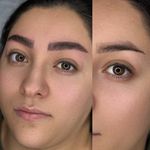 میکروبلیدینگ تخصصی زهرابدلی