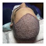 کاشت مو تبریز سونیتا