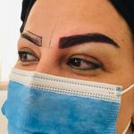 کاشت مو و ابرو ساچلی