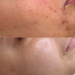 پاکسازی پوست،فشیال تخصصی در رودسر