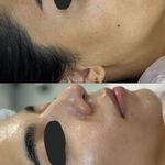 خدمات درماپلنینگ vip با اصلاح ابروی رایگان