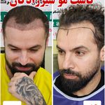 کلینیک کاشت مو مریم شیرزادگان