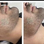 تزریق ژل و بوتاکس عبداله کوخی