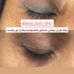 مرکز لیزر الماس