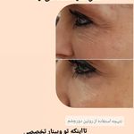 خدمات درمان جوش و لک ناهیدی