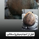 مریم درویشی میکرواسکالپ سر در اهواز