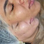 فیشال و پاکسازی پوست درنواب