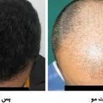 کلینیک کاشت مو و ابرو رویان شیراز