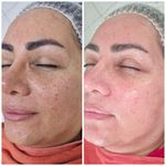 فیشال و پاکسازی پوست درنواب