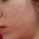 فیشال درمانی و پاکسازی پوست میرجلیلی