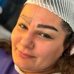 کاشت مو -کاشت ابرو -کاشت ریش شکیبا