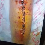 شکسته بندی استاد شهرزاد حکیم