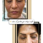 جوانسازی صورت و گردن