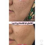 تخفیف ویژه بوتاکس پی ار پی مزوتراپی مزوژل لوکسیوا