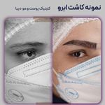 کلینیک کاشت مو دیبا