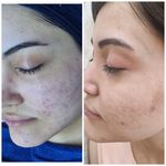 فیشال و پاکسازی پوست درنواب