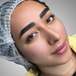 میکروبلیدینگ و فیبروز المیرا