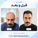 کاشت مو و ابرو