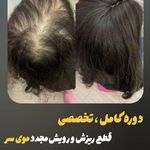 مرکز قطع ریزش و رویش مو و ریش عابدینی