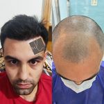 کاشت تخصصی مو،ابرو و ریش هاشمیان