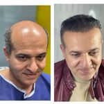 کلینیک تخصصی کاشت مو رشت