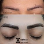 میکرو، شیدینگ لب ریموو تتو میکرواسکالپ ندا