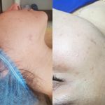 فیشیال و پاکسازی پوست مریم