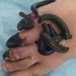 حجامت، زالو درمانی، فصدخون.برداشتن خال امجدیان