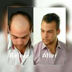 کلینیک کاشت مو پاسارگاد