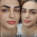 مرکز میکروبلیدینگ شیدینگ ریموو اسکالپ