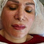 فیشال درمانی و پاکسازی پوست میرجلیلی