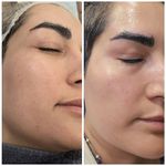 فیشال و پاکسازی پوست درنواب